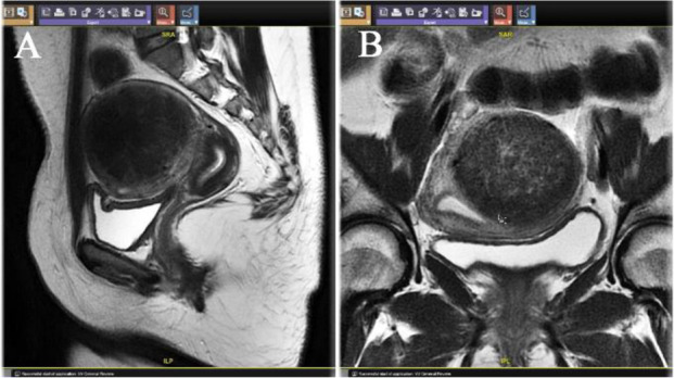 Figure 3. A) Sagittal T2 w image showing a single fibroid in the left posterolateral wall of uterus. B) Axial T2w image showing large fibroids in posterolateral wall